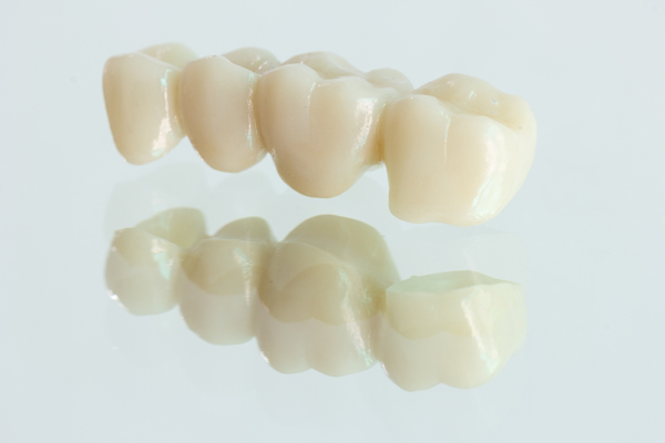 Dental Bridges Vs  Implants: Which Is The Better Tooth Replacement Option?